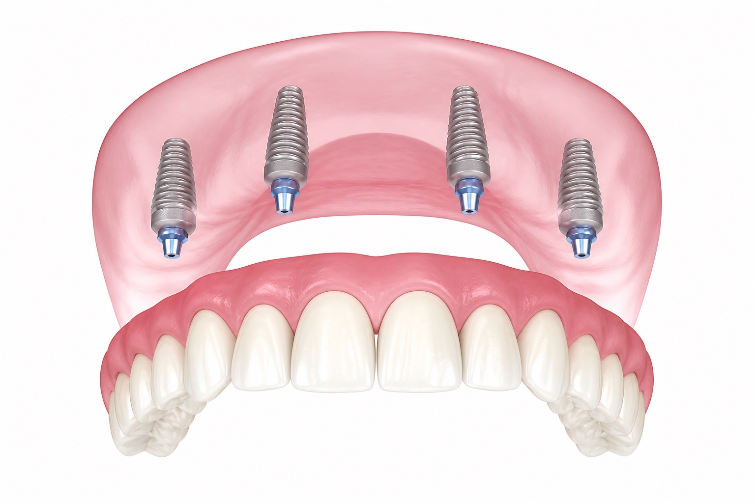 All-on-4 full-arch prosthesis supported by four dental implants