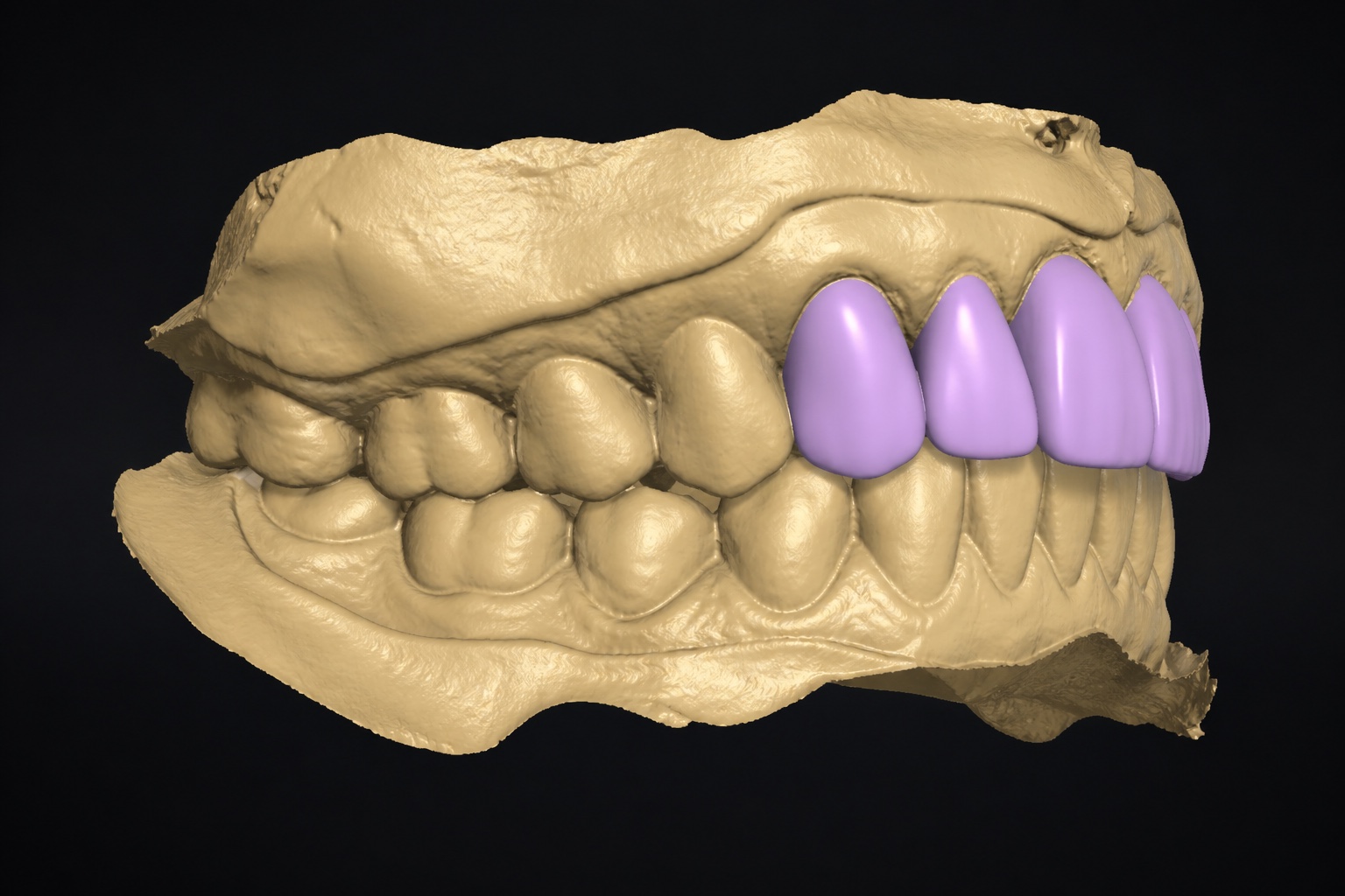 Why Stored Digital Scans Are a Game-Changer for Denture Wearers