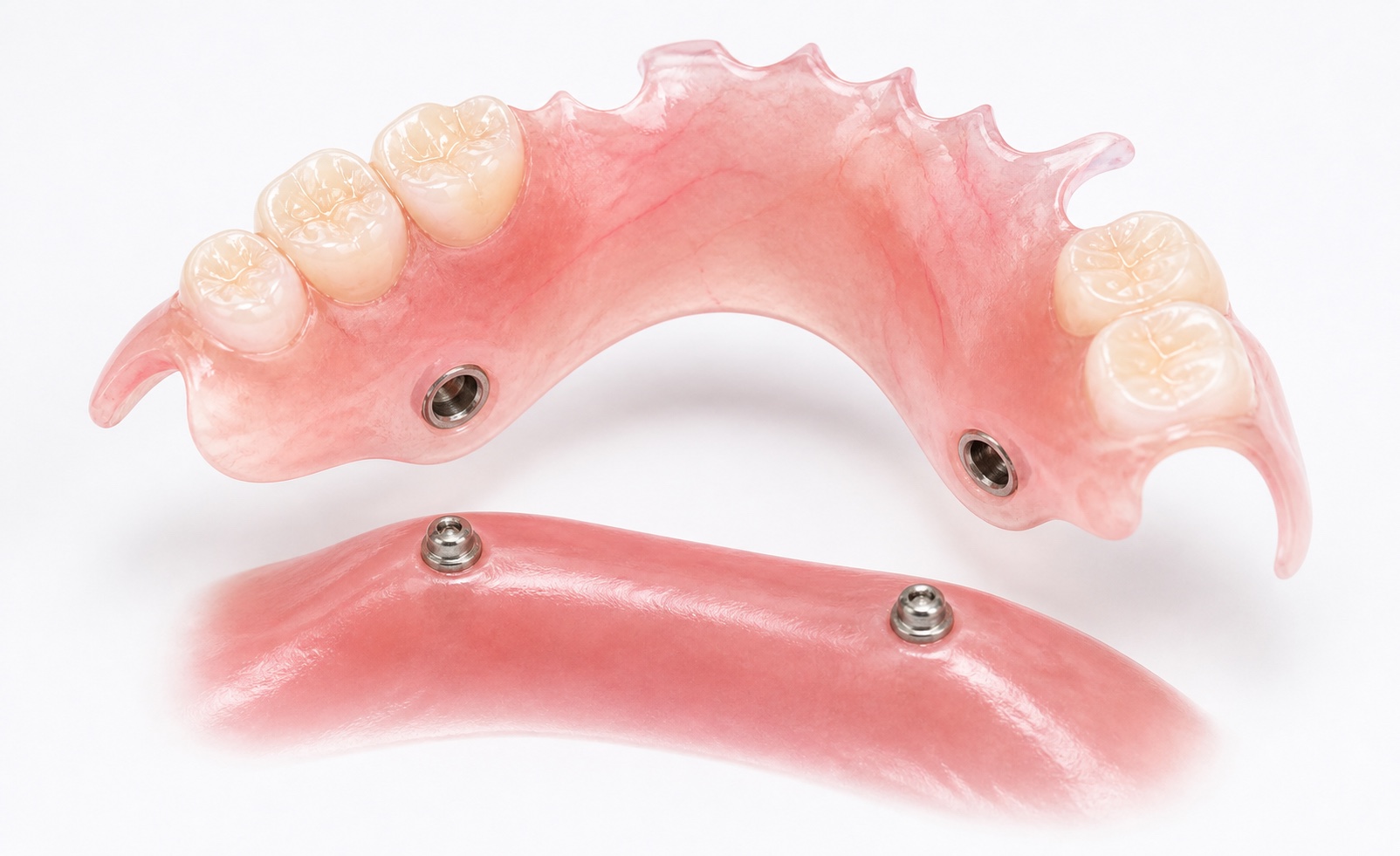 Implant-retained partial denture with two locator attachments