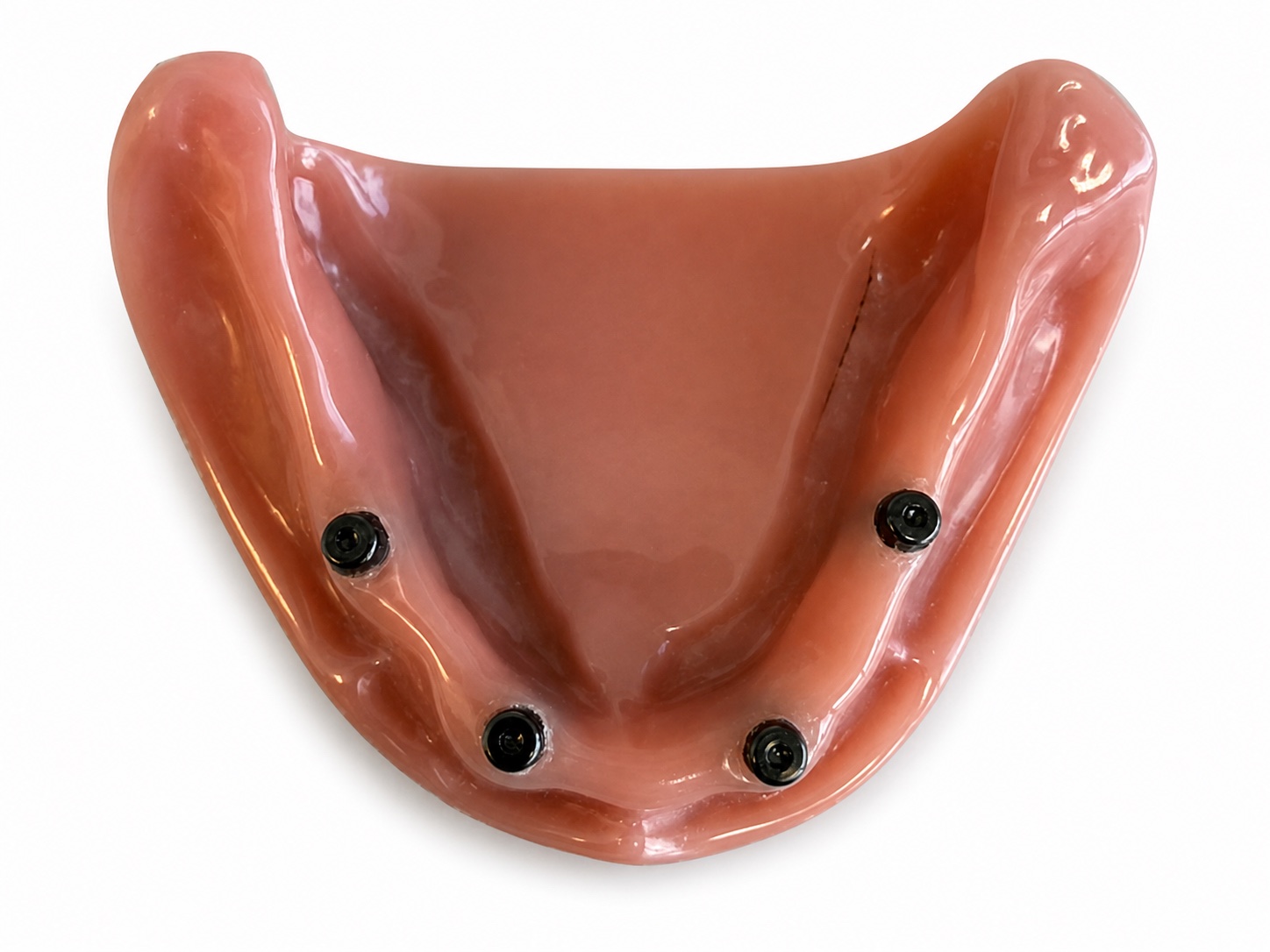MyBite snap-on overdenture showing four attachment housings