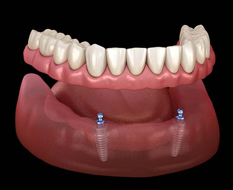 Implant overdenture options — locator and bar retention