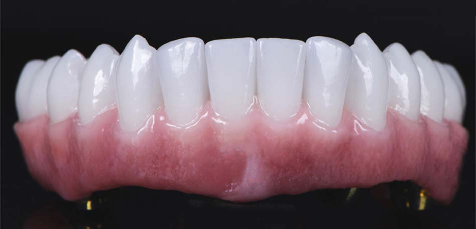 Complete Dentures Calgary